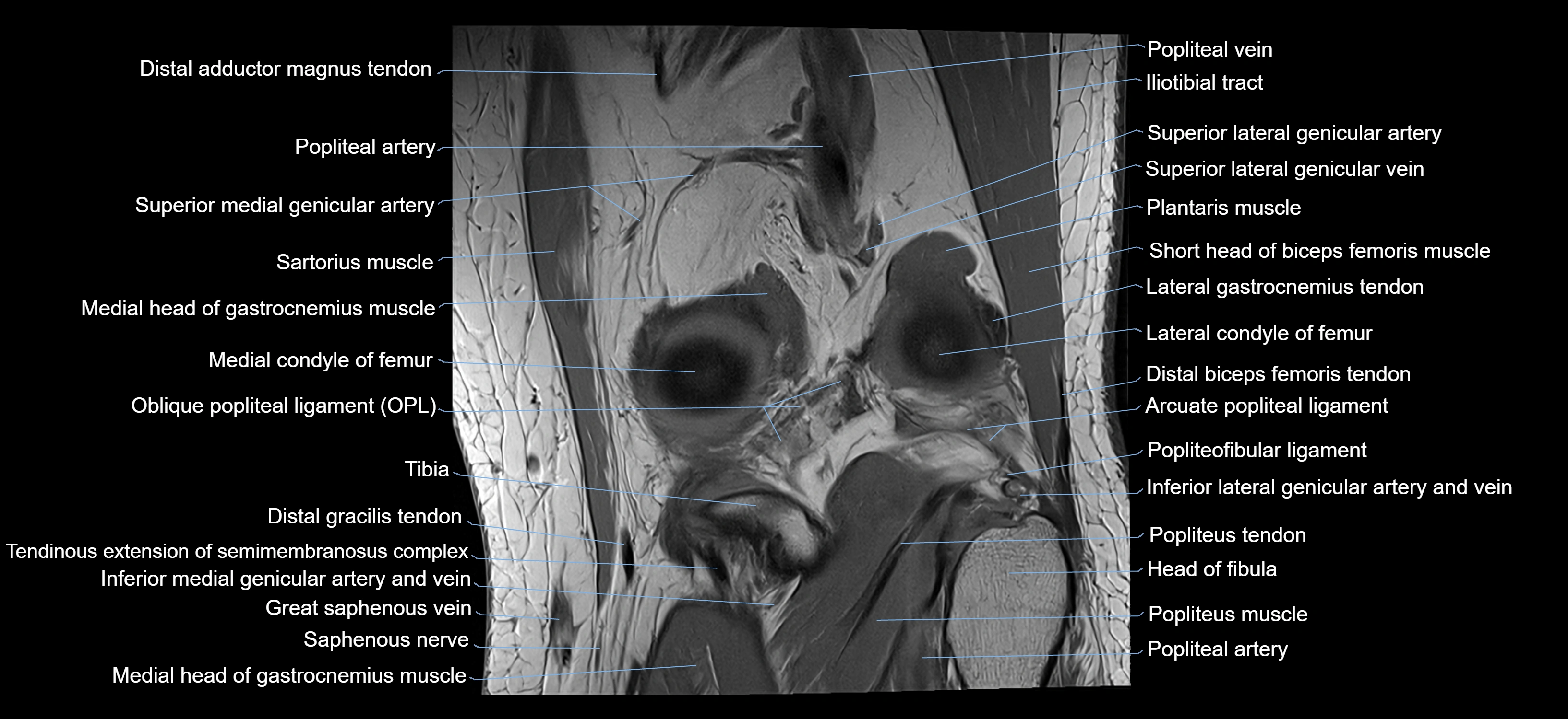 MRI knee coronal cross sectional anatomy labelled 3T radiology  image-04001-00029.webp